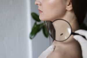 controllare un neo che cresce figebo dermatologia