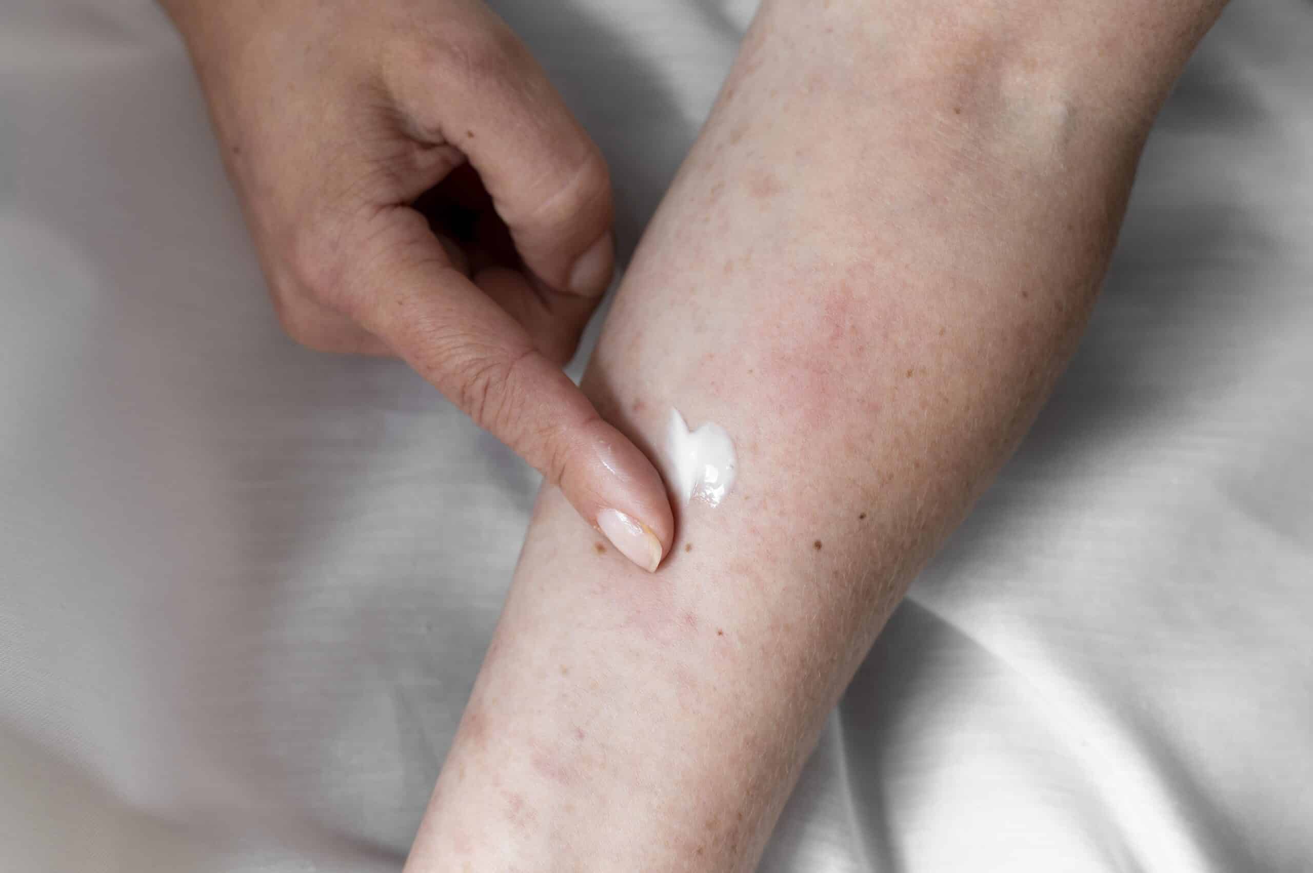 Macchie rosse sulla pelle: dermatite o qualcosa d’altro?
