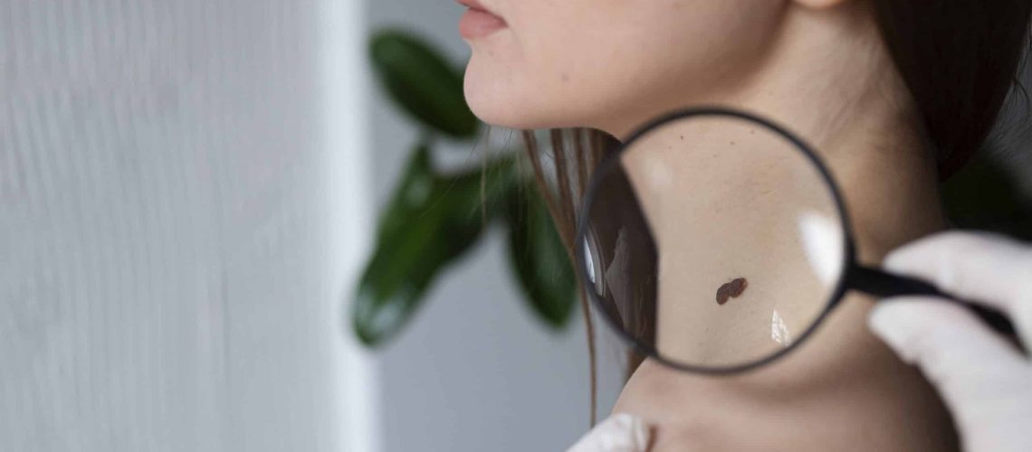 controllare un neo che cresce figebo dermatologia